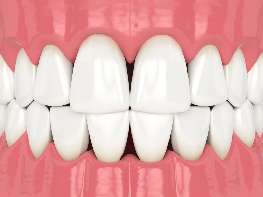 What are black triangle teeth