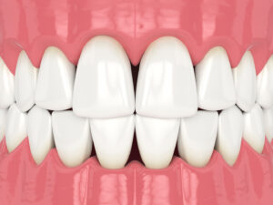 What are black triangle teeth